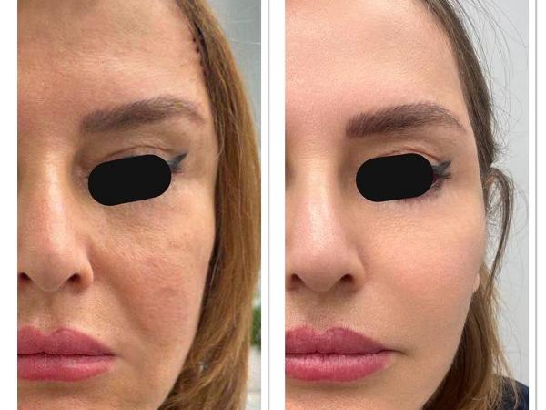 هزینه آر اف فرکشنال ترمیا چقدر است؟