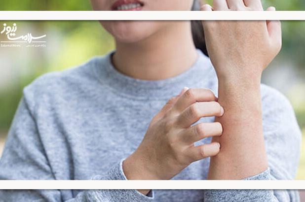 آلرژی ناشی از لوازم آرایشی؛ شایع اما قابل پیشگیری