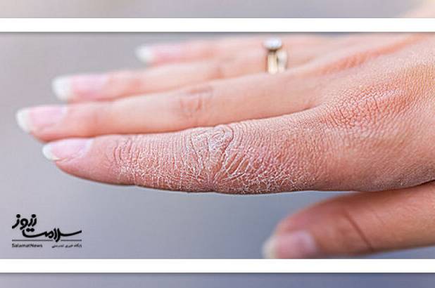 خطاهای رایج پوستی در هوای سرد