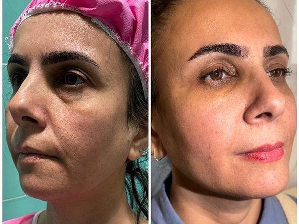 جوانسازی صورت به روش نوراریژن؛ روشی ترکیبی با ماندگاری بالا