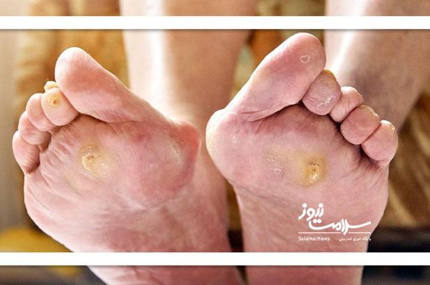 راهکار مقابله با زخم پای دیابتی