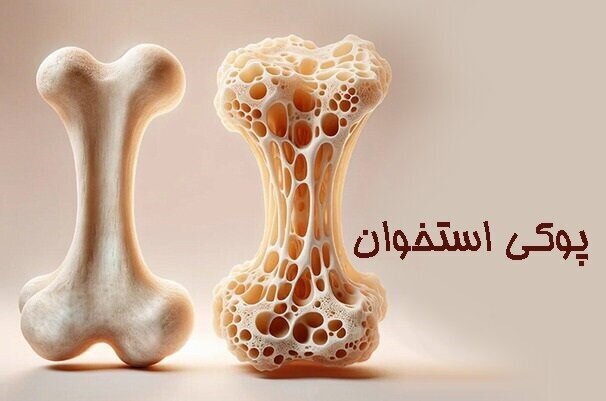 ۴۶ درصد عامل پوکی استخوان در ایلام کم‌تحرکی است