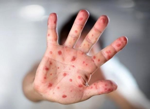 ابتلای ۴۲۲ نفر به سرخک در ۳ ماه اول سال/ شیوع بالاتر بیماری در ۲ استان