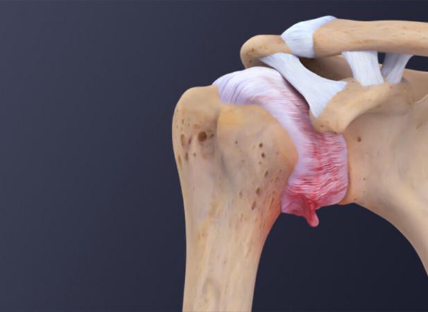اهمیت بررسی ابتلا به بیماری های زمینه ای در سندروم شانه یخ زده