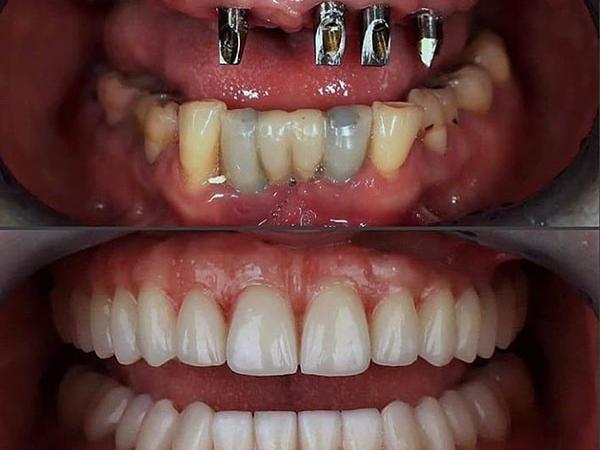 ایمپلنت کامل فک بالا و پایین (فول موس) چگونه انجام میشود؟