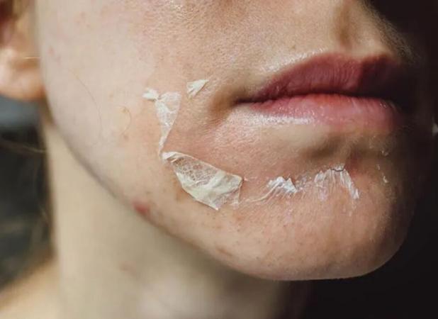 عوارض اسیدتراپی پوست صورت؛ چه زمانی باید نگران باشیم؟