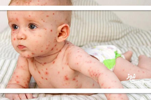 شایع‌ترین بثورات ویروسی در نوزادان