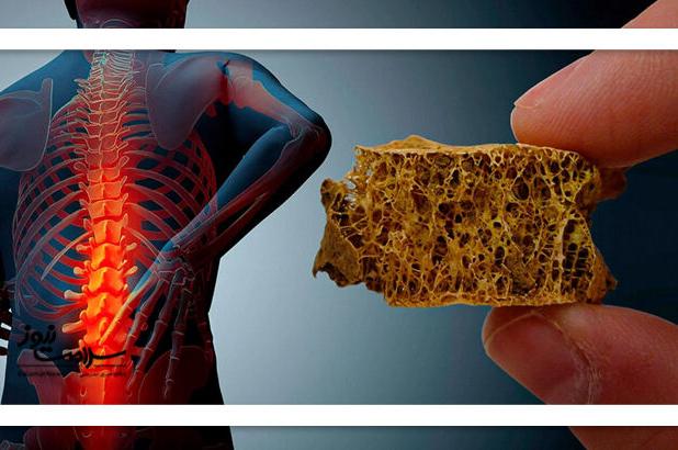 پوکی استخوان از دهه چهارم زندگی آغاز می‌شود؛ پیشگیری از جوانی ضروری است