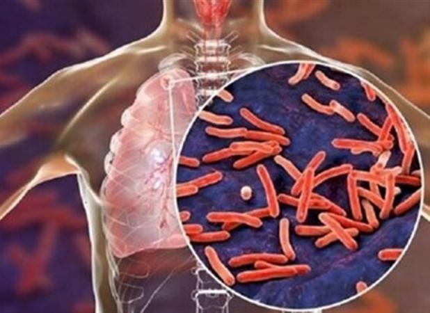 شیوع کرونا باعث کاهش تشخیص بیماری سل شده است