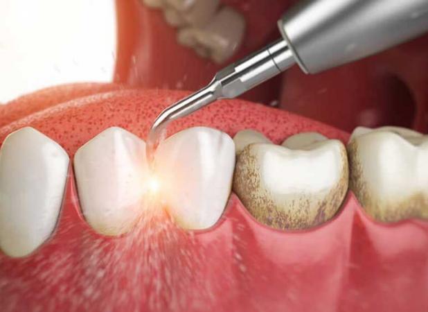 چرا باید جرم گیری دندان را جدی بگیریم؟