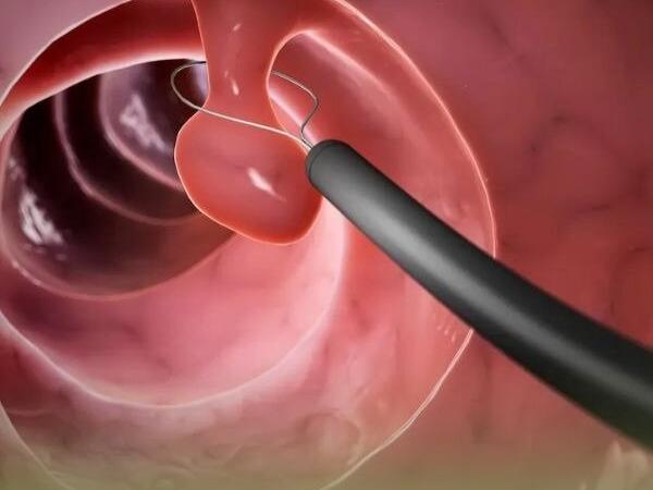 کولونوسکوپی چیست و چگونه انجام میشود؟