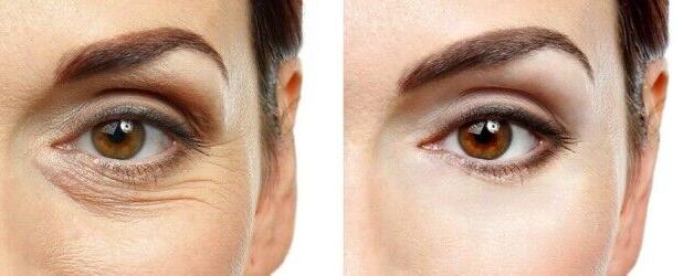 گودی و سیاهی زیر چشم؛ علت و راهکارهای رفع آن