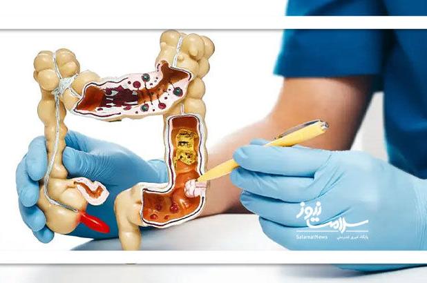 رابطه متقابل تغذیه و بروز سرطان‌های دستگاه گوارش