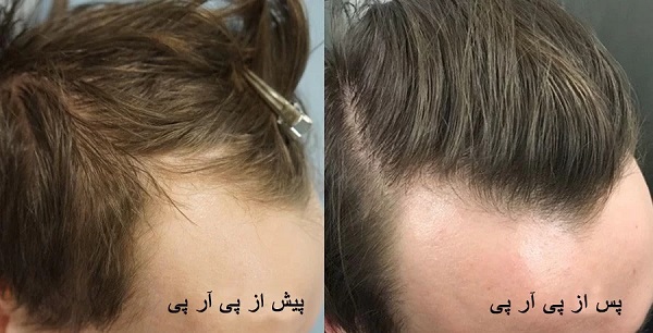پی آر پی مو چیست و چگونه باعث درمان ریزش مو می شود؟