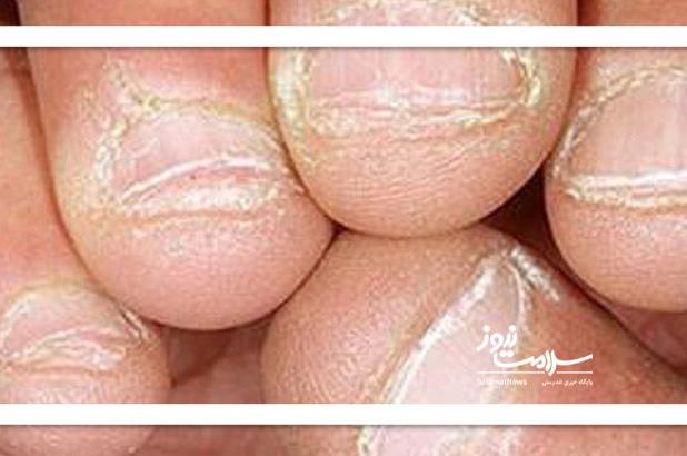 چرا دور ناخن پوسته پوسته می‌شود؟