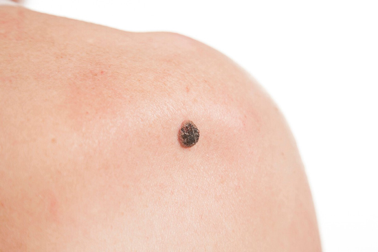 روش‌های از بین بردن خال و زائده‌های گوشتی