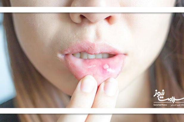 زخم‌های کوچک دهان؛ هشدار جدی سرطان
