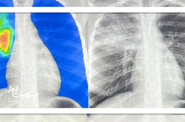 موارد ابتلا به سل در جهان به بالاترین سطح تاریخی رسید؛ ۸.۳ میلیون نفر مبتلا در ۲۰۲۴"