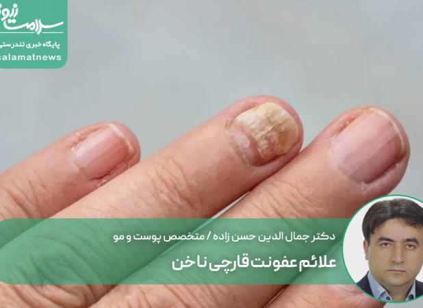 علائم عفونت قارچی ناخن