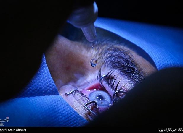 شیوع قوز قرنیه در ایران بالاتر از جهان/چه عواملی باعث بروز بیماری می‌شود؟