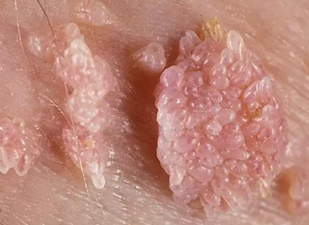 بهترین مرکز درمان زگیل تناسلی (ویروسhpv) در تهران + لیست ۱۰تایی