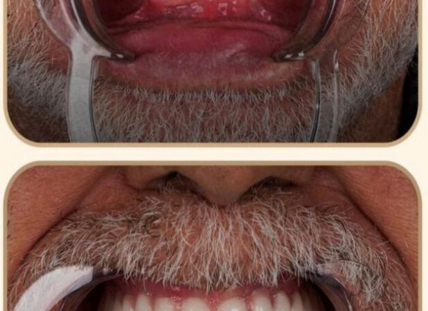 از مشاوره تا کاشت: تجربه کامل بیماران با ایمپلنت DPI