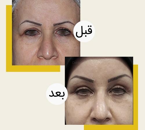 عمل جراحی پلک بالا و پایین (بلفاروپلاستی) چگونه است؟ + عکس