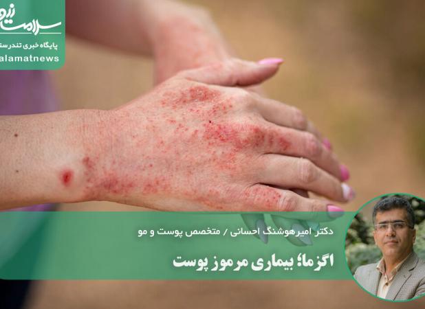 اگزما؛ بیماری مرموز پوست