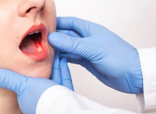 افزایش سرطان دهان در ایران؛ خطر برای افراد بالای ۵۰ سال و مصرف‌کنندگان مواد دخانی