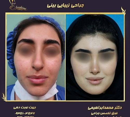 عمل جراحی بینی سربالا + ترمیم بینی خوکی