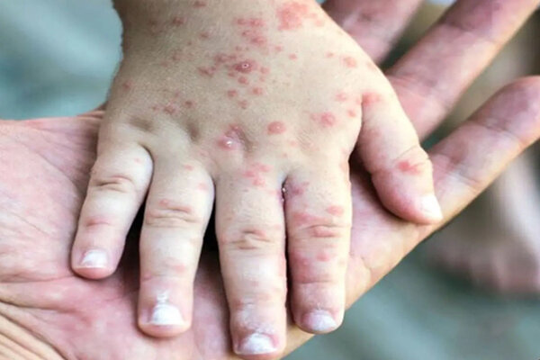 مشاهده سرخک در سه شهرستان استان فارس