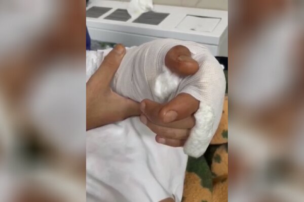 پیوند موفقیت آمیز دست قطع‌شده یک جوان زاهدانی