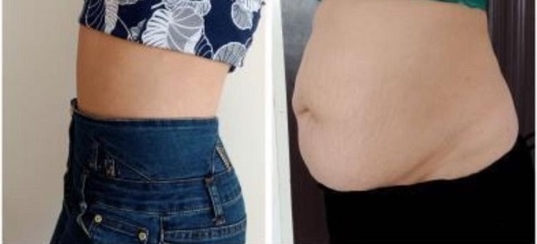 پیکرتراشی ارزان | هزینه انواع روش (لیپوماتیک و...) در سال ۱۴۰۴