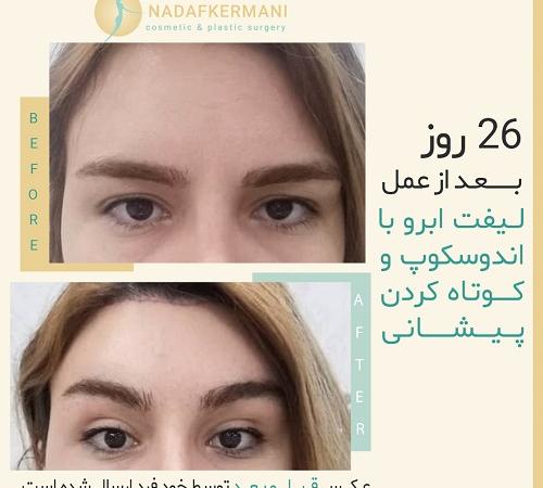 لیفت ﺍبرو با اندوتاین چیست و چگونه انجام می‌شود؟