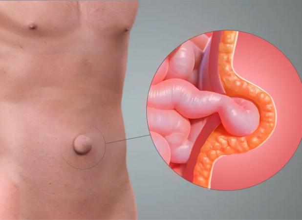 آیا می‌توان فتق را بدون بیهوشی درمان کرد؟ بررسی راهکارهای موجود