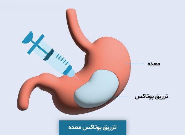 بوتاکس معده چیست و چطور باعث لاغری می شود(مزایا+عوارض)