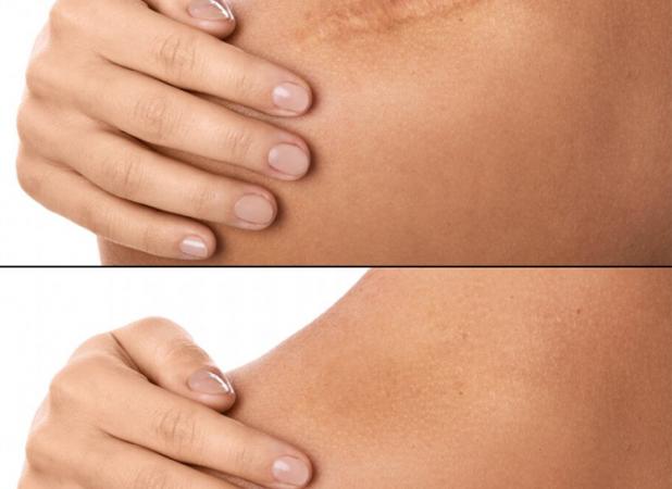 مقایسه درمان جای زخم با سلول‌های بنیادی و لیزر؛ کدام مؤثرتر است؟