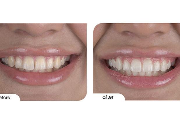 بلیچینگ با لیزر ؛ روشی نوین برای سفید کردن دندان ها