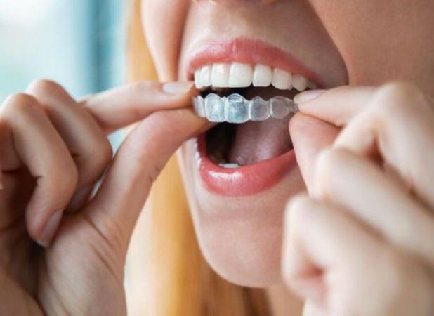 مرتب کردن دندان بدون ارتودنسی