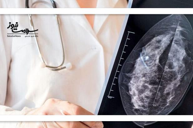 توسعه سامانه هوشمند تشخیص زودرس سرطان پستان در ایران / دومین پایگاه داده ماموگرافی جهان ایجاد شد