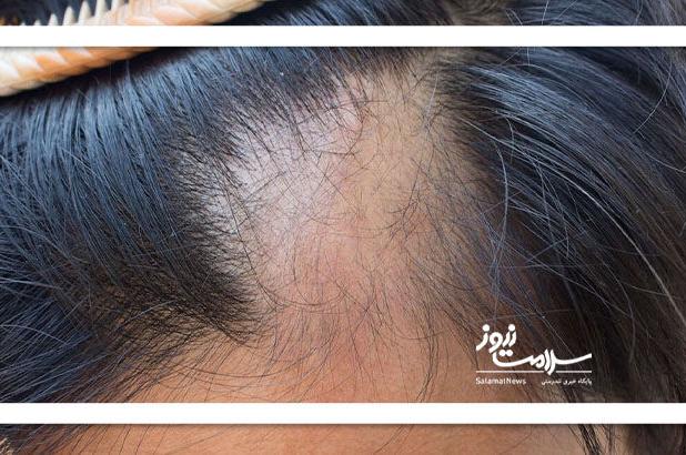 فیناستراید رفع طاسی یا مرگ ناشی از خودکشی!