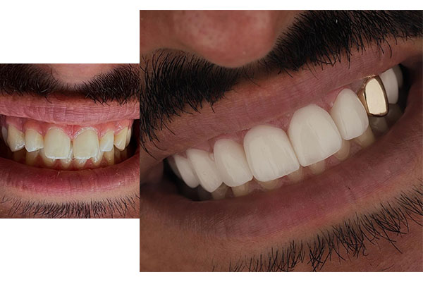 اصلاح طرح لبخند با کامپوزیت + مزایا و معایب