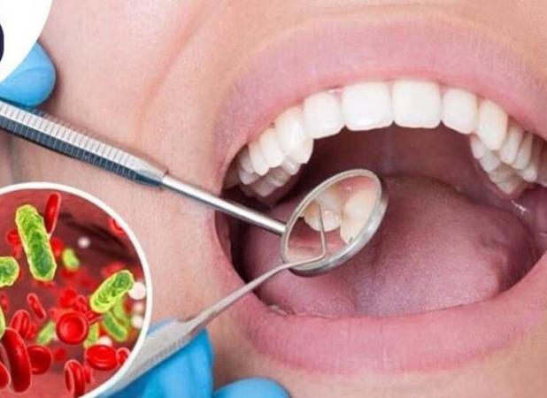 آیا ممکن است عفونت ریشه دندان پس از عصب‌کشی برگردد؟