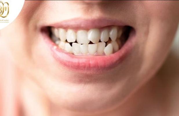 روش های اصلاح کجی دندان‌ها در بزرگسالی