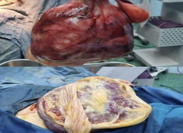 نجات مادر سنندجی از توده ۵ کیلویی