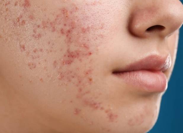 درمان جدید آکنه از راه رسید