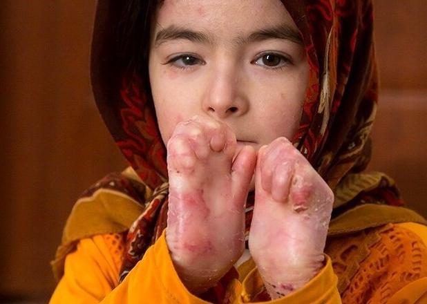 تجدید فراخوان تامین پانسمان‌های بیماران پروانه ای