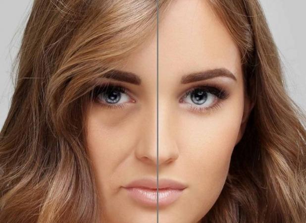 تزریق چربی به صورت | مراحل، مزایا و عوارض