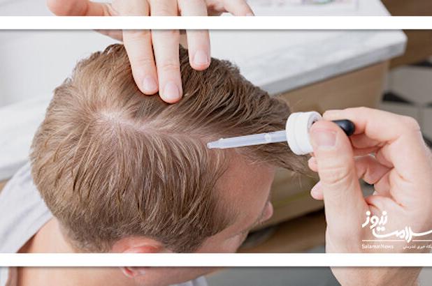 پروکاپیل در مقابل ماینوکسیدیل: کدام برای ریزش مو بهتر است؟