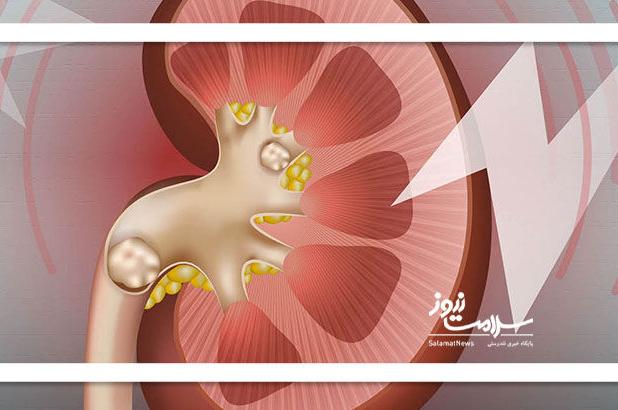 علائم، درمان و باورهای غلط درباره سنگ کلیه